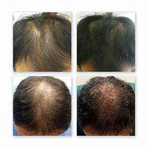 Hair Regrowth Laser Helmet With LED Lights - Beautyic.co.uk