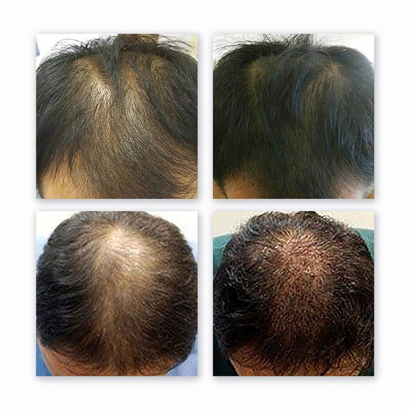 Hair Regrowth Laser Helmet With LED Lights - Beautyic.co.uk