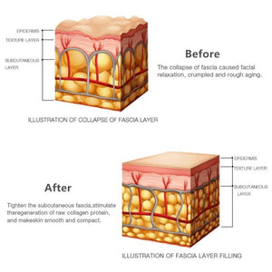 HIFU Facial Beauty Device For Bags Under Eyes Puffy Eyes Device - Beautyic.co.uk