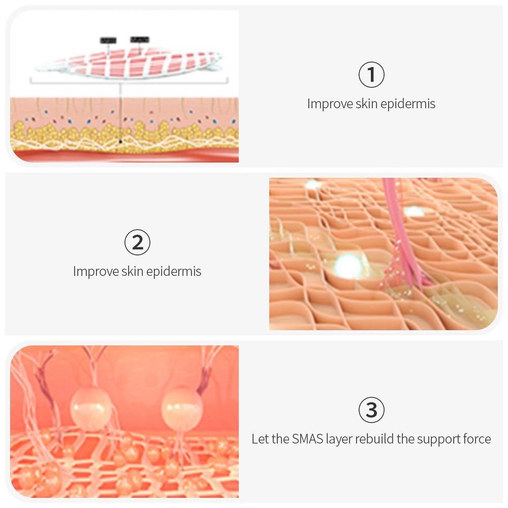 HIFU- High Intensity Focused Ultrasound Device - Beautyic.co.uk