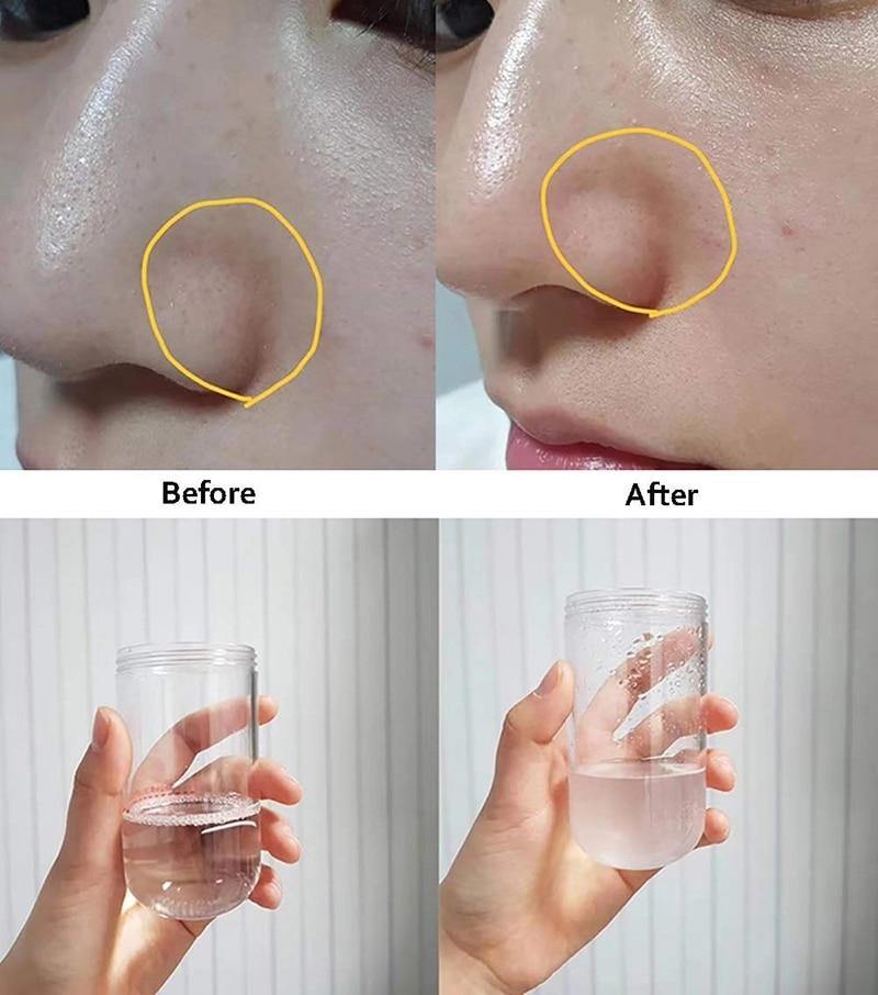 Blackhead Remover Pore Vacuum Water Oxygen Jet Beauty Machine Multifunctional Facial Suction Machine Cleaning Microdermabrasion Skin Care Instrument - Beautyic.co.uk
